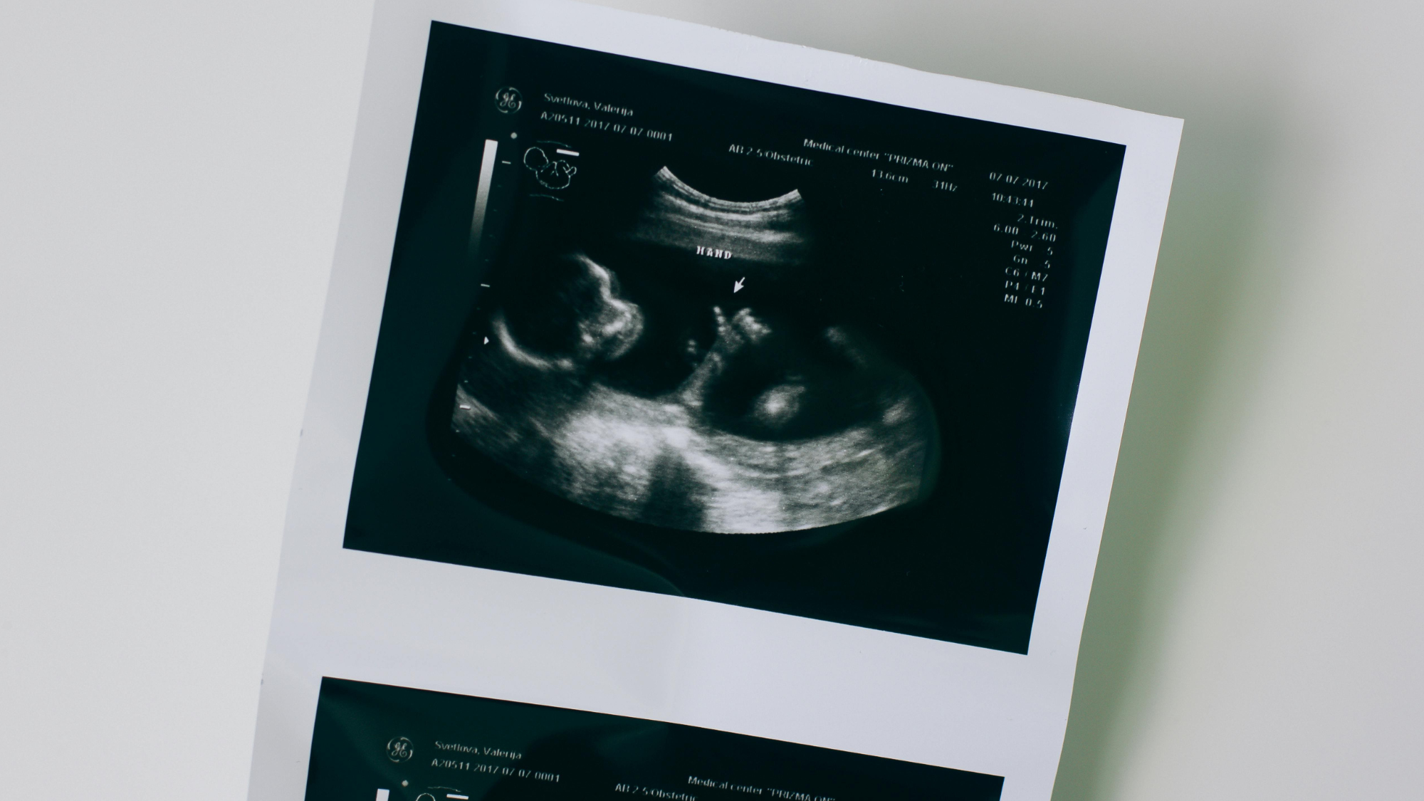 PGT-A Results Explained: My 7 Embryos, 5 Viable Story